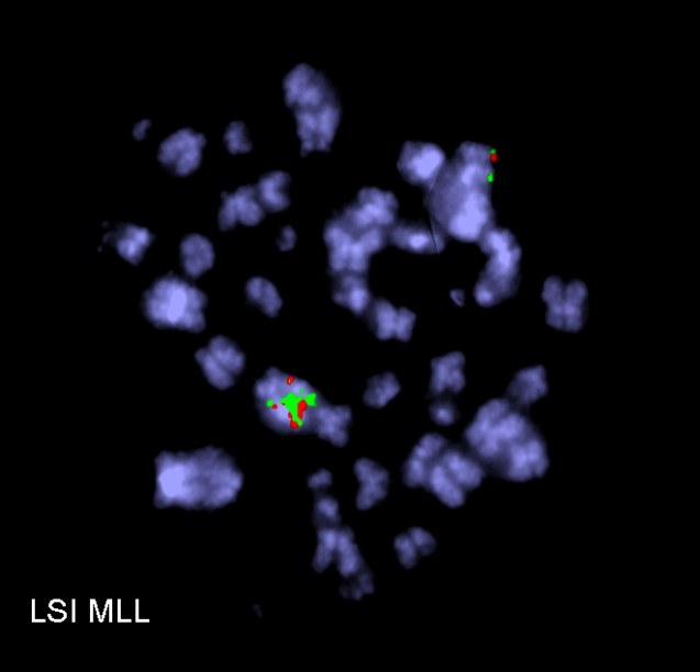 Pathological chromosomes of bone marrow cell of female with acute myeloid leukemia