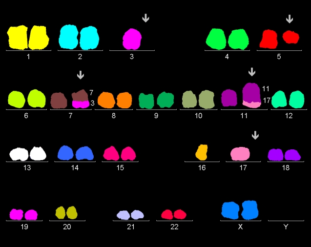 Karyotype of bone marrow cells of female with komplex chromosomal rearrangements: