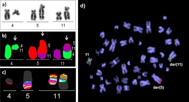 Results of classical cytogenetic and FISH analyses of patient with AML: